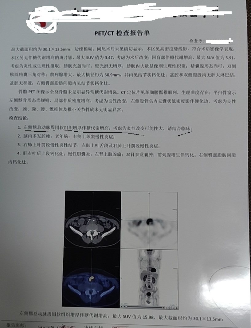 做完阑尾炎手术后肚子胀气怎么办,阑尾炎手术后肚子胀气多久能消失