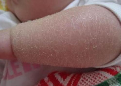 宝宝皮肤上有鱼鳞状,刚出生的宝宝长了鱼鳞病