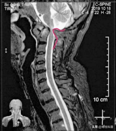 脊柱手术脑脊液漏的临床表现,脊柱术后脑脊液漏的病例