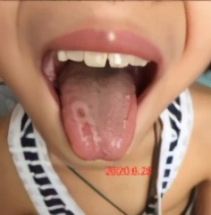 小儿地图舌治疗怎么推拿,儿童地图舌药膳