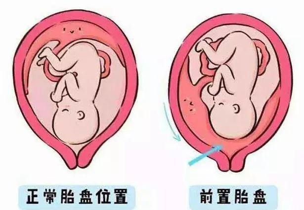 孕产｜发现“前置胎盘”怎么办？