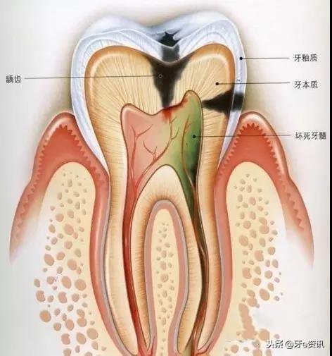 补牙和根管治疗有哪些区别,补牙和根管治疗有何不同