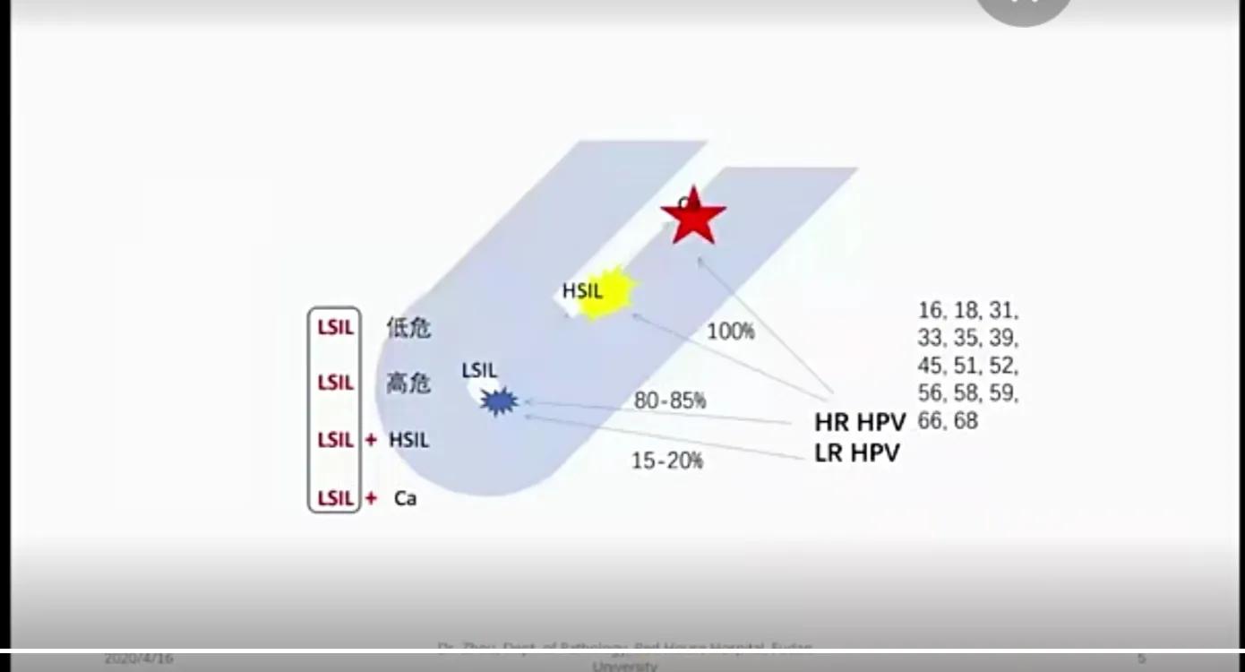 宫颈低级别鳞状上皮病变LSILCIN1,宫颈鳞状上皮内病变lsil是什么