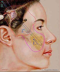 听医生讲副作用,做拉皮手术恢复真实感受