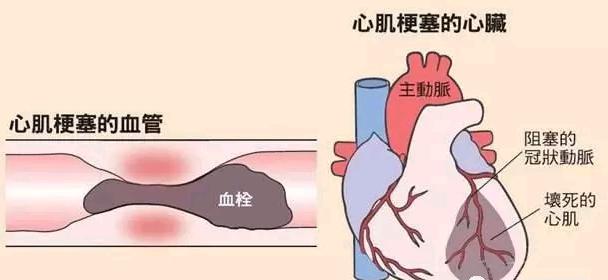 心肌梗死后多久可以恢复运动,心肌梗死后一个月还用支架吗