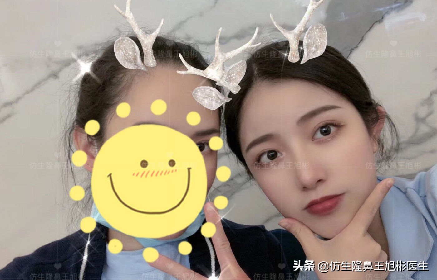 手术鼻头增厚能用什么方法弄,大鼻头高鼻梁缩小手术案例