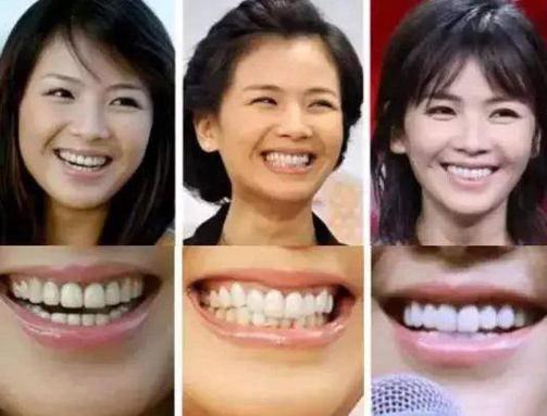 赵薇牙齿做了烤瓷牙吗,吴宣仪牙齿烤瓷牙
