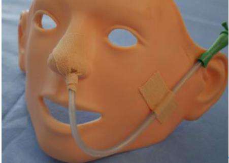 鼻饲胃管晚上呛咳,鼻饲胃管插好为什么会呛咳