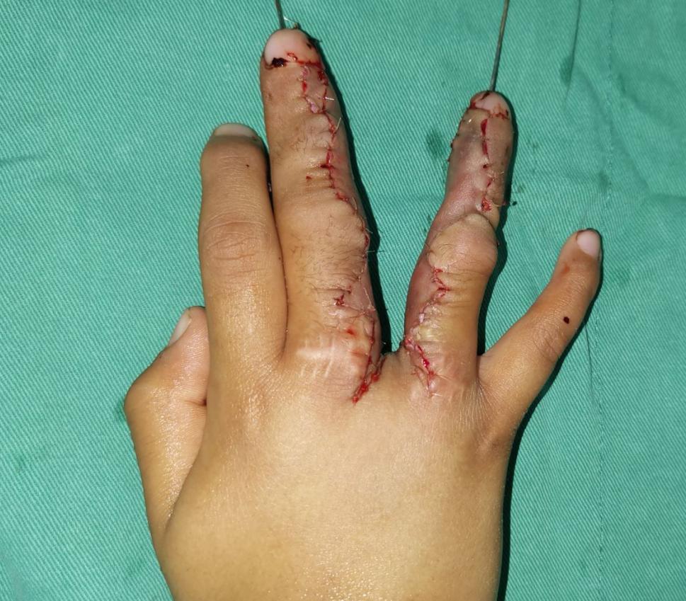 并指畸形免植皮案例,并指畸形