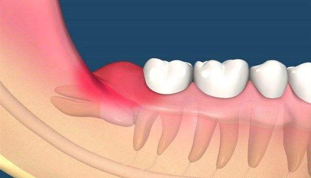所有人拔智齿都会肿吗,智齿拔了以后智齿还有什么用