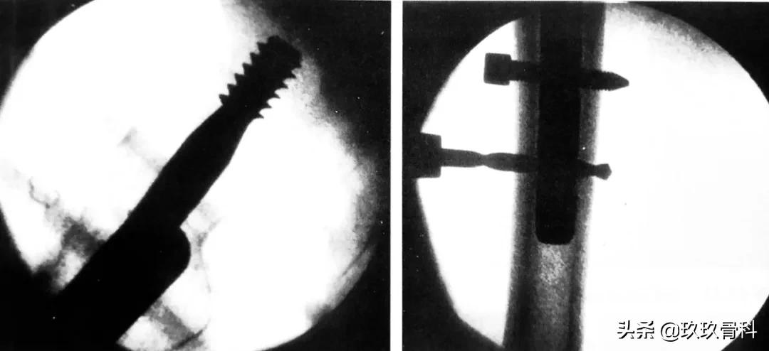 骨科用髓内钉什么材料,骨科髓内钉的作用