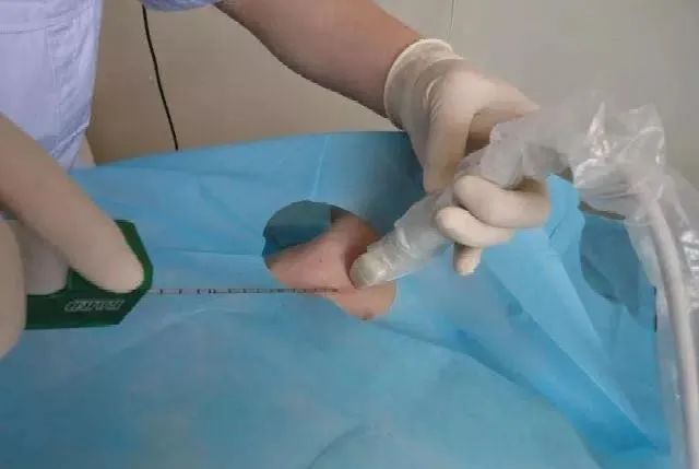 为什么肿瘤患者都拒绝做穿刺活检,穿刺活检恶性还能手术吗