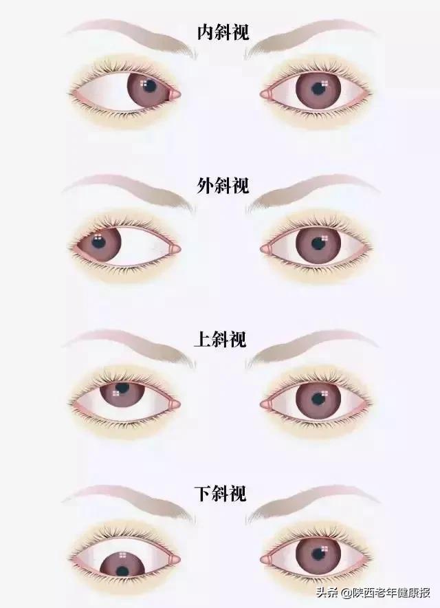 宝宝视力检查异常是什么意思,宝宝眼睛的异常现象