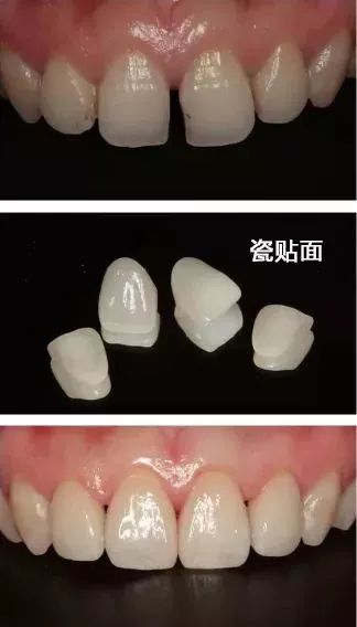 牙缝1cm太大医生说补不了,牙缝上面细下面大能补吗