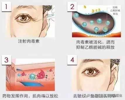 先改善细纹还是先修复抗衰,眼部显老怎么做抗衰