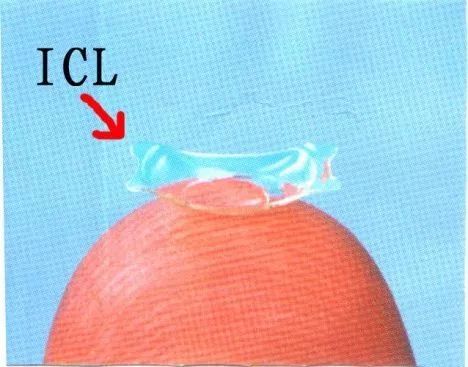 800度近视做飞秒手术还是晶体植入,800度的近视怎么治