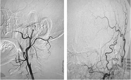 颈动脉狭窄介入治疗的后遗症,颈动脉闭塞介入手术是局麻吗