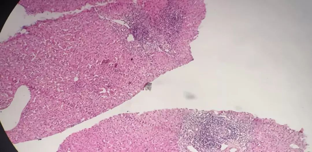 精华回顾｜肝胆精英荟：肝脏炎症性损伤的临床及病理鉴别诊断——杨永峰教授