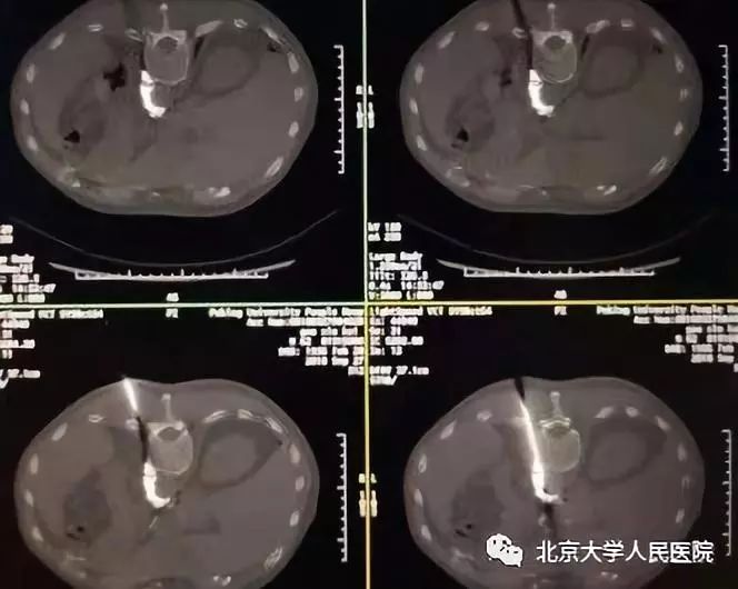 科普胸痛千万不要大意,医生科普疼痛科