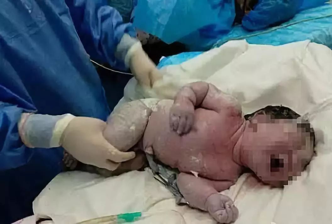 健康平安生孩子需要注意什么,生孩子是剖宫产比较痛还是顺产痛