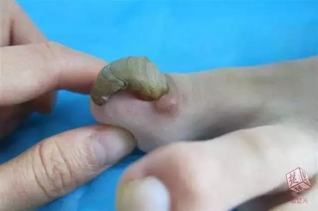 十六岁女孩六年不剪脚趾甲,11岁女孩没有剪过指甲