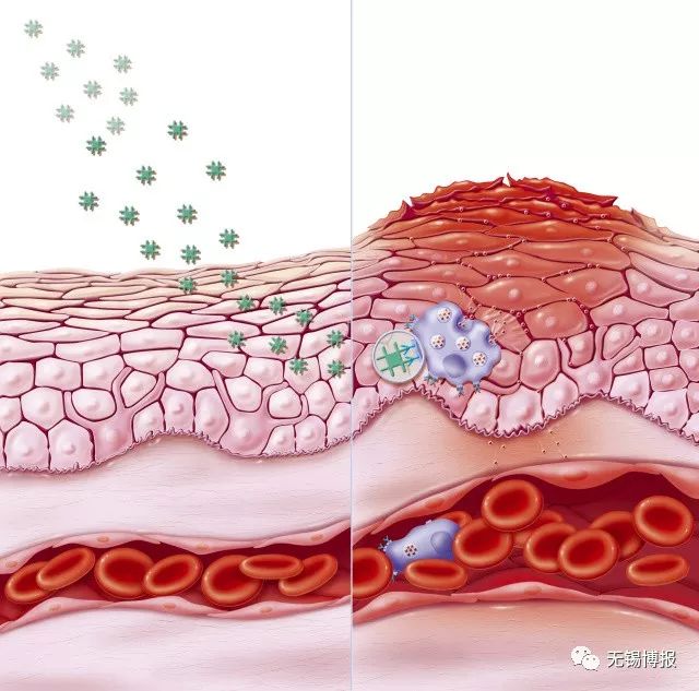 共享大医生｜带状疱疹痛让人恼？疼痛科了解一下