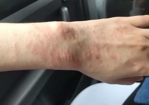 被海葵蜇了排毒要多久,戴着手套会被海葵蜇到吗