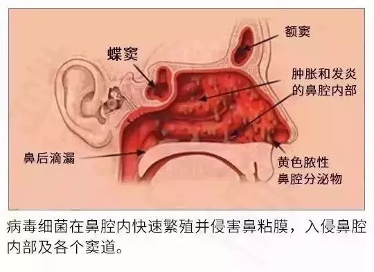 根治鼻炎只需一招,治鼻炎不复发