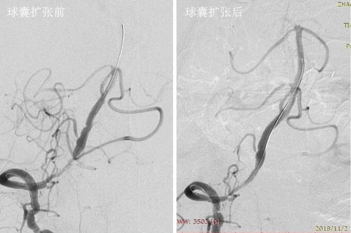 椎动脉起始段狭窄的介入治疗ppt,椎动脉v4段假性动脉瘤介入治疗