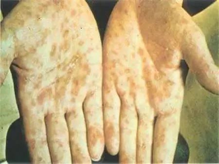 男子查出严重梅毒,男子被查梅毒后续