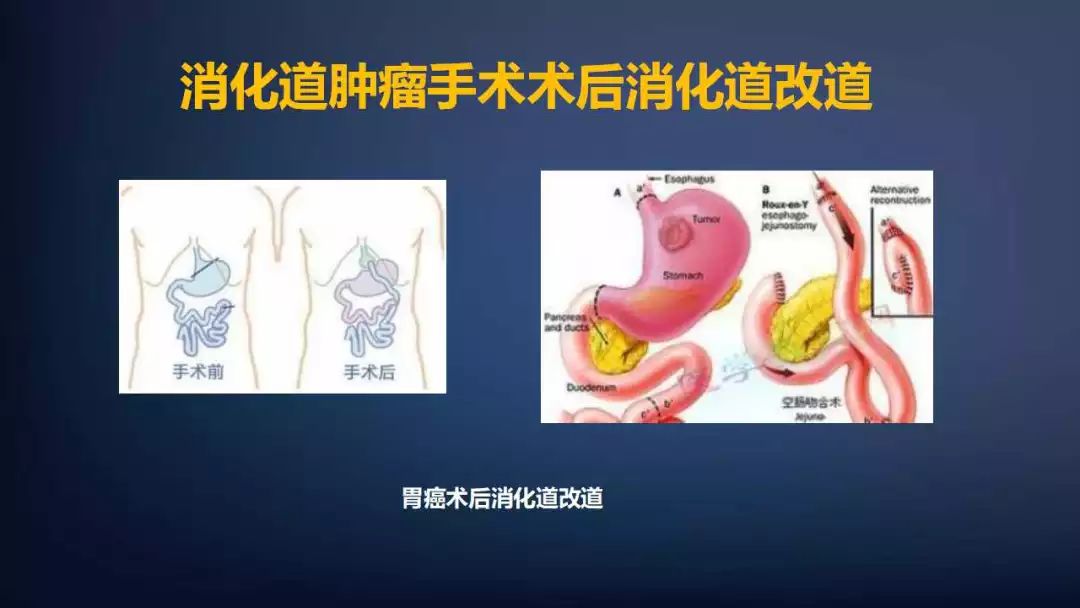 肿瘤课件,肿瘤医疗课件制作思路