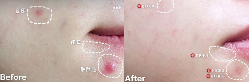 推荐的祛痘面膜青春期,祛痘紧急修复面膜