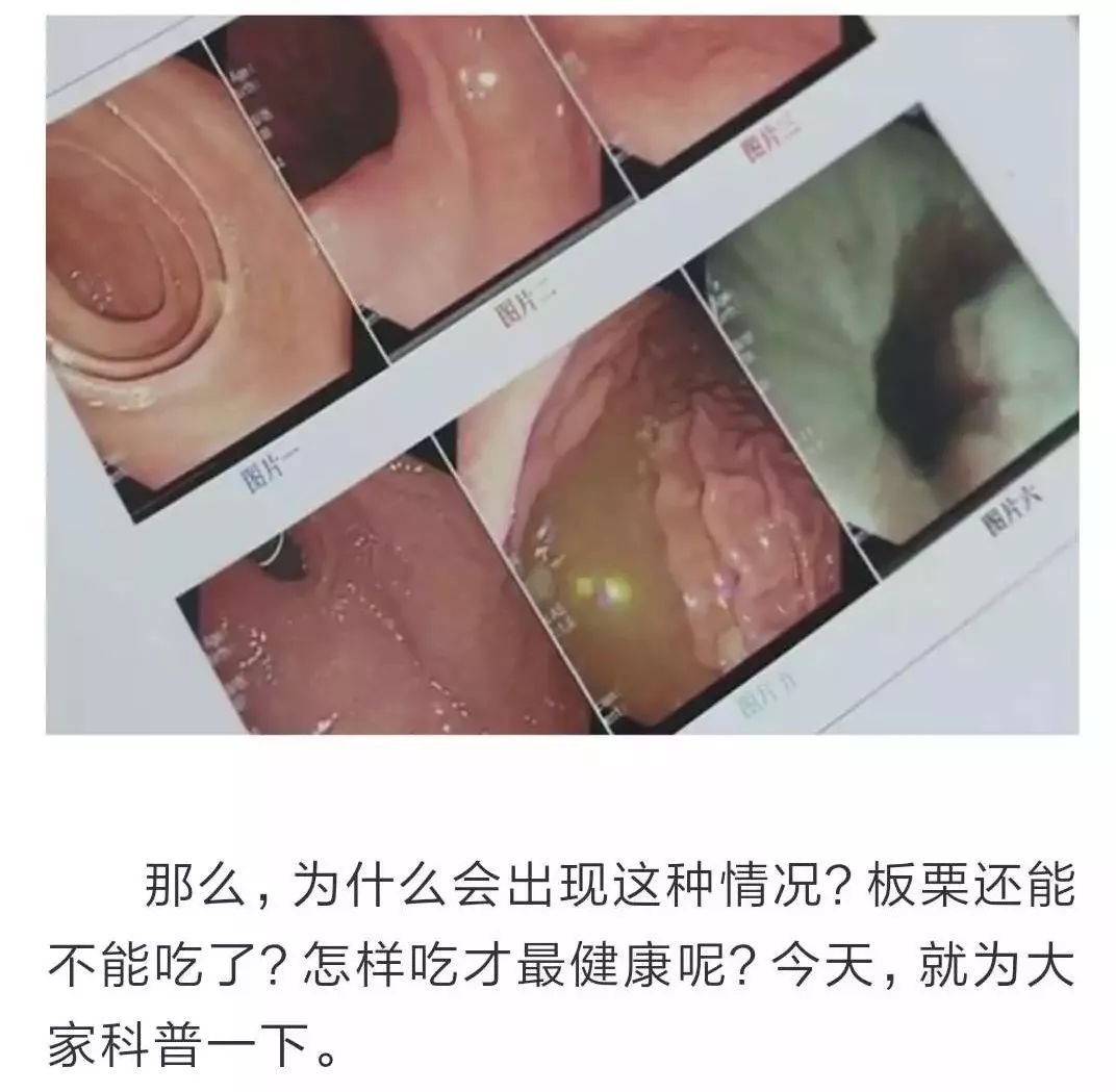 栗子吃多了烧胃怎么处理,吃栗子呕吐怎么回事啊
