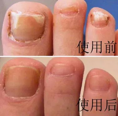 十年灰指甲可以治好吗,一次搞定顽固灰指甲