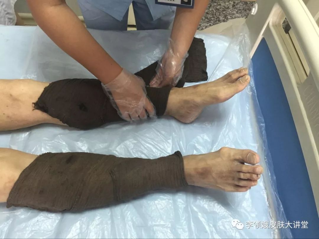 「杏林微科普」湿疹,我该拿你怎么办?——防护治疗篇