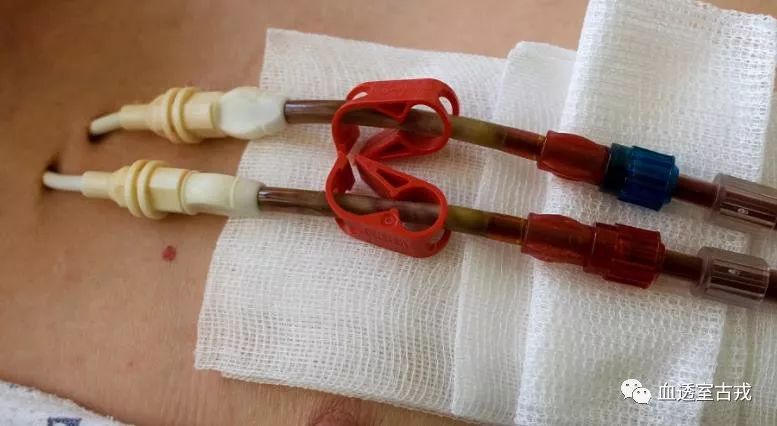 中心静脉导管使用方法视频,中心静脉导管护理技术操作标准