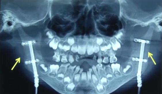 小孩子8岁了嘴巴合不拢,5岁小孩经常心疼怎么回事