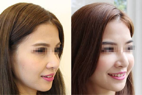 玻尿酸填充是个无底洞吗,玻尿酸是不是无底洞