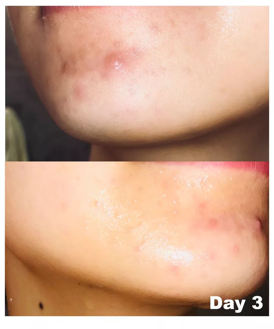 怎么对付闭口,终于找到了对抗失眠的良方