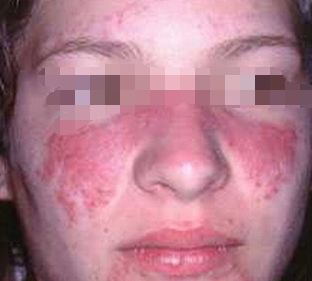 什么症状要看风湿免疫科,风湿免疫性疾病有哪些症状