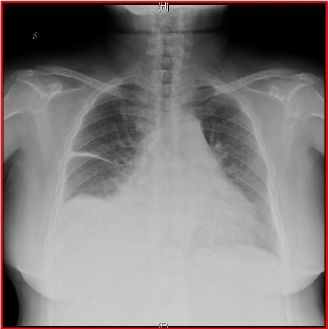 做完消融手术后胸闷憋气,射频消融术后胸闷气短是怎么回事