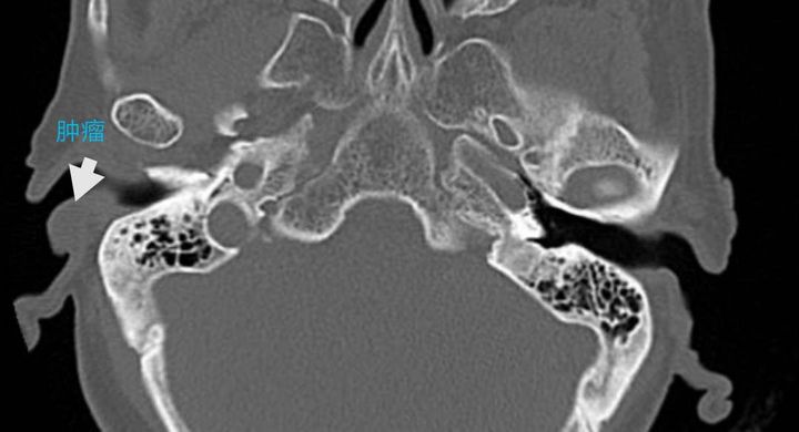 只因这个小动作，八旬老太耳里长出颗“黑蚕豆”，一查竟是癌！