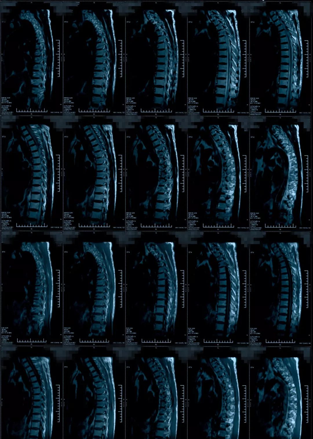 椎管狭窄水肿最佳治疗方法,椎管水肿如何治疗