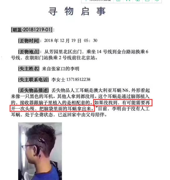 人工耳蜗丢失辟谣,人工耳蜗丢失真实事件