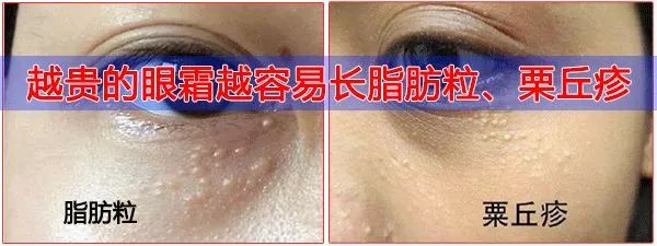 50岁没有眼袋眼纹黑眼圈,60岁去眼袋的最佳方法