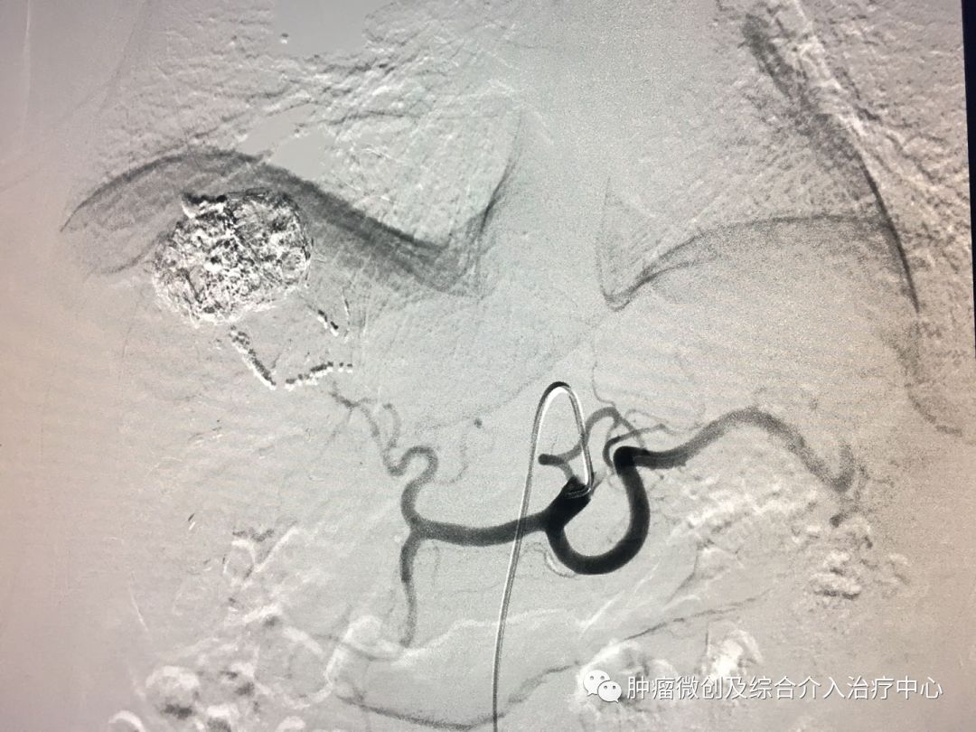 运城市第一医院肿瘤科咋样,运城第一医院治疗肿瘤怎么样