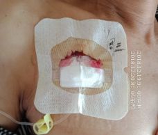 还在为静脉曲张发愁吗,输液港渗血处理方法