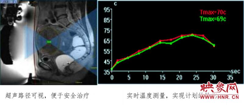 震颤治疗中心,磁波刀治疗特发性震颤患者的案例