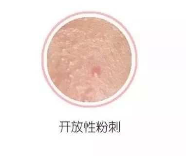 皮肤反复长闭口是什么原因,闭口痘痘反复长是什么原因