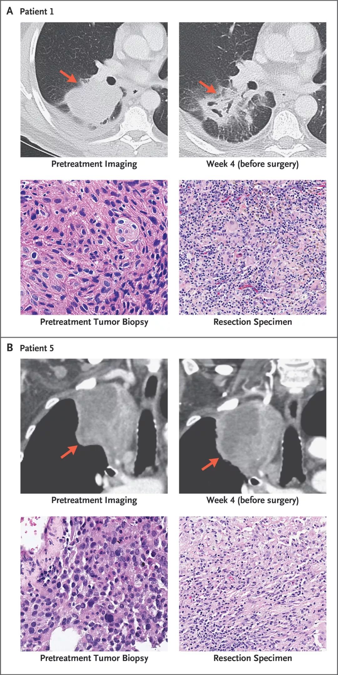 「我们都被结果惊呆了」：免疫新辅助治疗，正在改写早期肺癌的治疗现状，这无疑也是中国临床的新机遇丨奇点搜神记